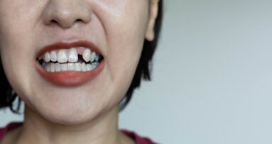El control deficiente de la glucemia y la pérdida de dientes