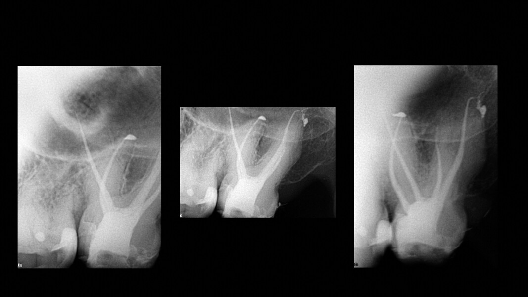 Figs. 7a–c : Radiographies prises immédiatement après le traitement, montrant l’obturation tridimensionnelle du système des canaux radiculaires sous différents angles.
