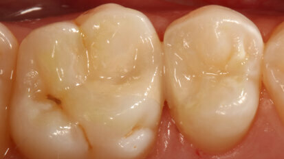 Long-term restorative glass hybrids—eco-friendly and cost-effective evolution from GC