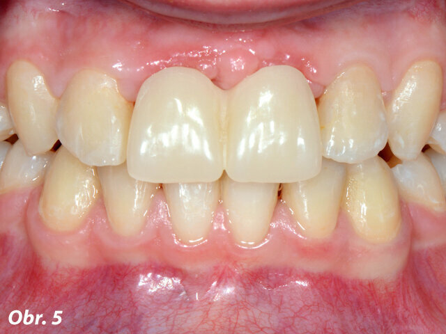 Obr. 5: Pacientka s provizorní náhradou po sejmutí ortodontického aparátu, výměně výplní a úpravě palatinální preparace zubů