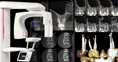 Nuova modalità di imaging endodontico da Planmeca - immagini dettagliate senza rumore o artefatti