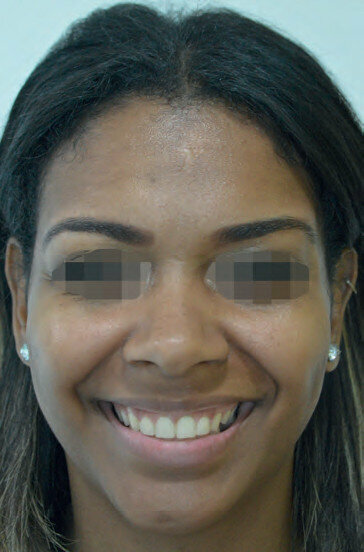 Fig. 4 : La patiente déplore toujours son sourire gingival. 
