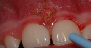 L’utilizzo del laser in ortodonzia