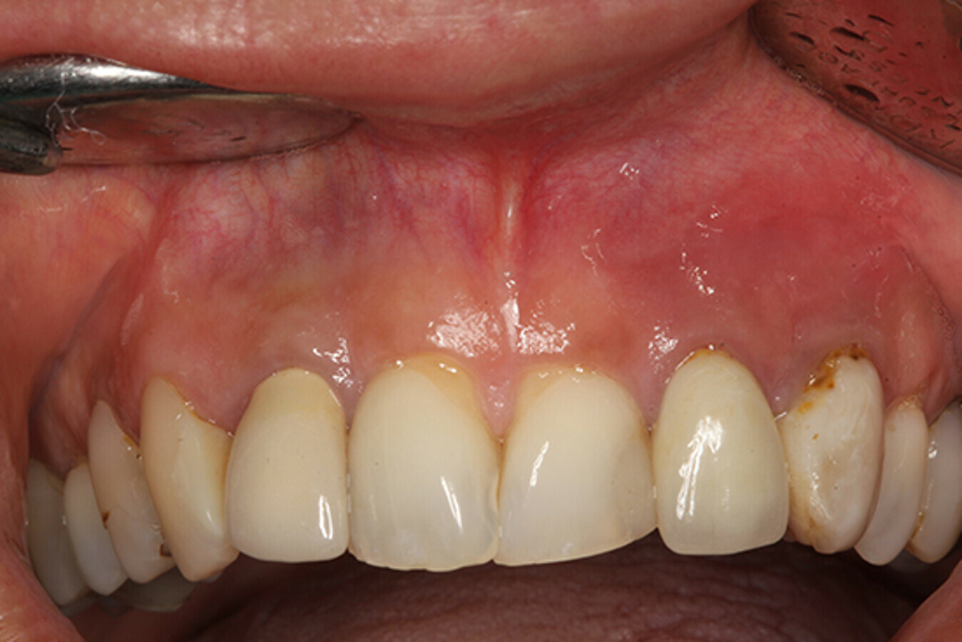 Figura 1. Imagen clÃ­nica de la regiÃ³n anterior maxilar de la paciente.
