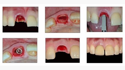 Immediate Implant Placement with Socket Shield Technique followed by Chairside Provisionalisation