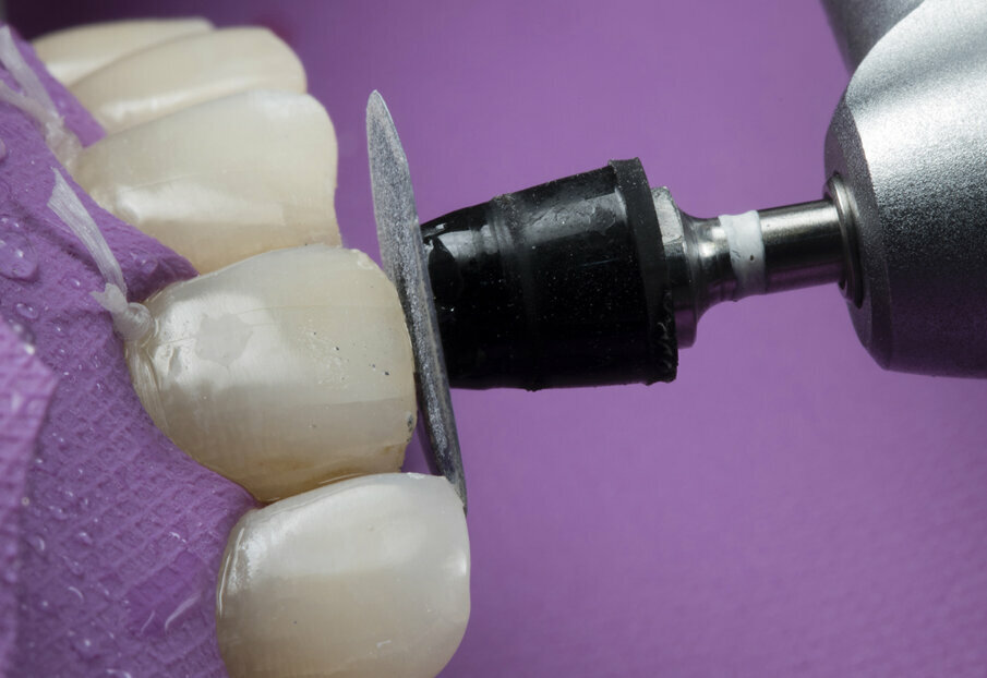 Fig. 6: Smoothing incisal edge with the Super Snap Black disk