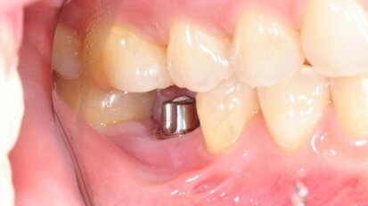 Inžinjeri razvili novi gel koji pouspješuje rast kosti oko zubnih implantata