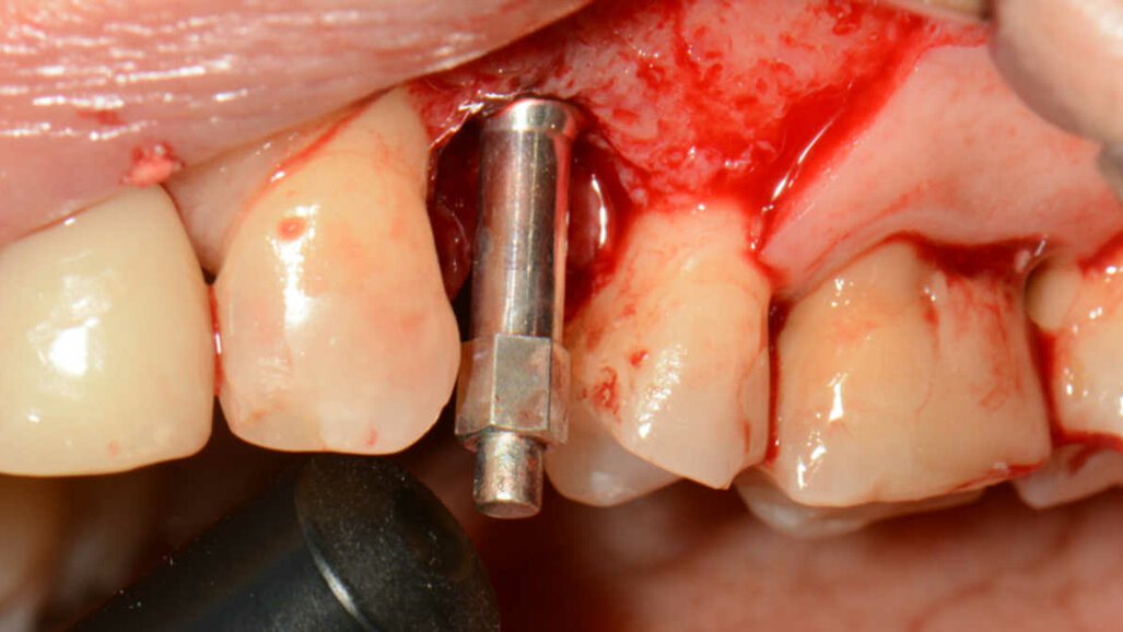 „Neprodáváme implantáty“ – rozvaha nad okamžitým zatížením dentálních implantátů