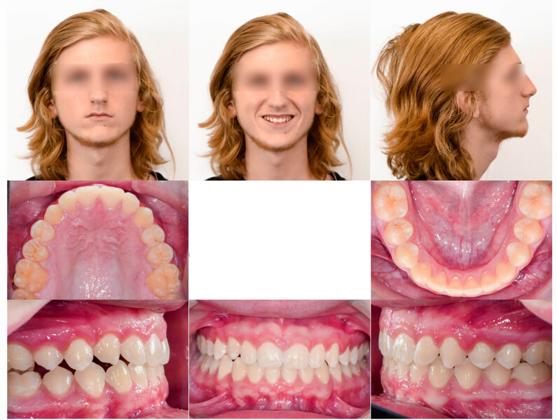 Figs. 7a–h: Progress photographs showing the maxillary right canine fully erupted. The patient was scanned for an additional series of aligners (refinement) to address the Class II occlusion on the right side.