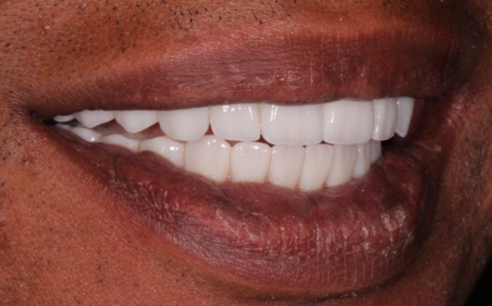 Fig. 28: Right lateral view of the patient’s smile.