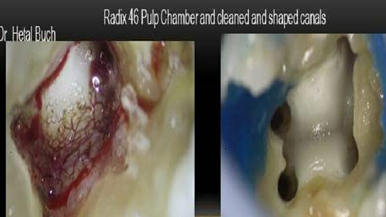 Radix 46 Pulp Chamber cleaned and shaped.