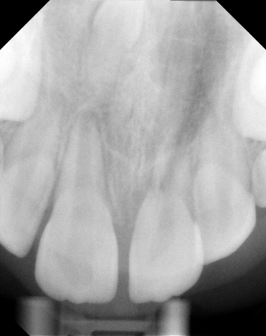 Figure 17c: Post op radiographs taken at 3, 6 and 12 months. They show lack of PDL some pulpal obliteration and replacement resorption. 