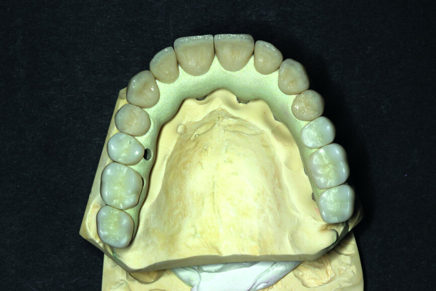 Fig. 14: Porcelain crowns based on a model prior to veneering by means of a pink composite.