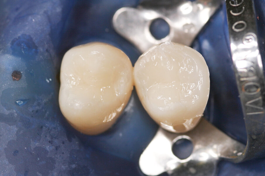 Fig: 8. After bulk-filling the Class II cavity with SDR® Plus the occlusal surface was reconstructed with a 2mm layer of ceram.x® SphereTEC™ one.