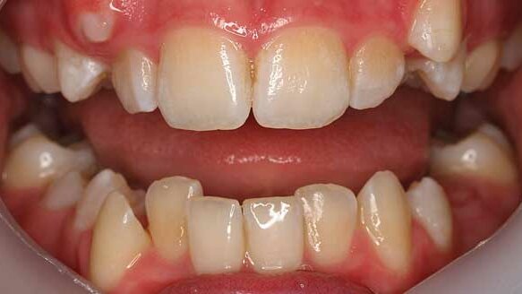 Hard to achieve orthodontic stability? Answer may be blowing in the wind