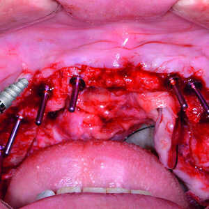 Fig-11-Insertion-d’un-implant-dentaire-Hahn-300x300-