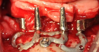 Implant ramowy podokostnowy w chirurgii implantologicznej – opis przypadku.