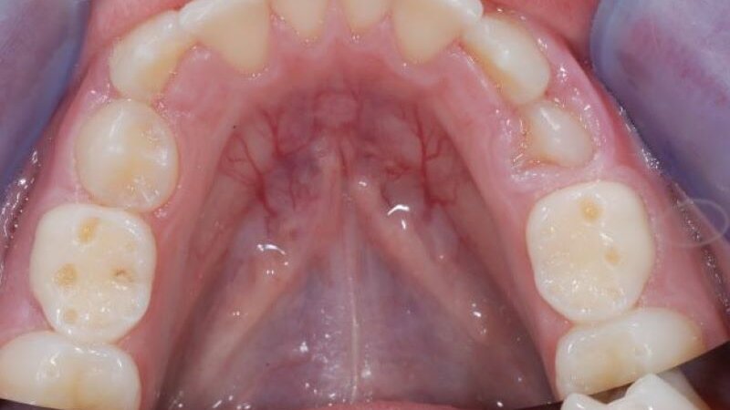 Erozije zuba – kako nastaju i kako ih kontrolisati?
