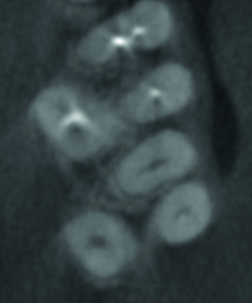 Figs. 1 et 2 : Tomodensitométrie à faisceau conique (CBCT) de la dent 27. 