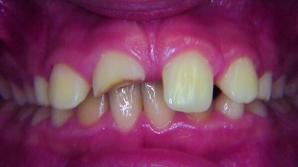 Les lasers dans le traitement de dents antérieures, fracturées à la suite d’un traumatisme