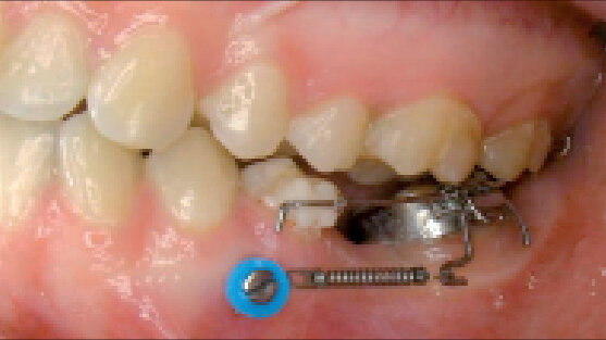 Miniimplantáty: ústřední bod ortodontické praxe. Část I. ze VI: Základy a historie kotvení – výběr šroubů