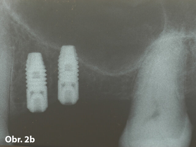Obr. 2b: Rtg snímek ukazující umístění implantátů