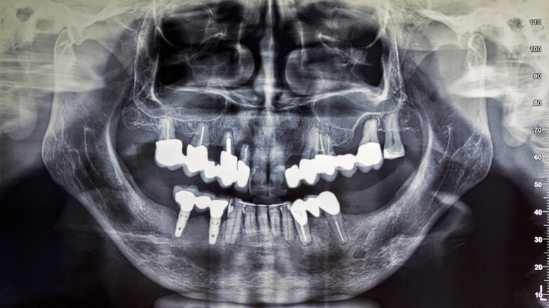 Reduced radiation dose in maxillofacial radiology yields comparable diagnostic results, study says