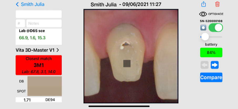 Fig. 17: Taking the shade of the prepared tooth into account.