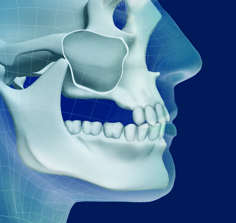 Figg. 1, 2_Schema di atrofia ossea verticale e trasversale posteriore del mascellare superiore.