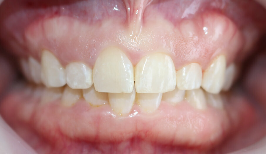 Fig. 1 Photograph showing the exostosis and gingival hyperplasia.