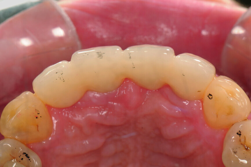 Fig. 46: After occlusal adjustment, the protrusive contact was even on the restoration (12 μm occluding paper, black).