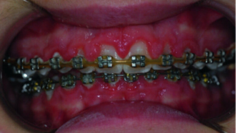 Use of diode laser in the treatment of gingival enlargement during orthodontic treatment