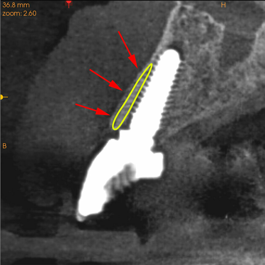 Fig. 28b: The post-op cross-sectional view clearly illustrated the position of the implant (a), the definitive restoration located palatal to the root membrane (b),
as outlined in yellow (red arrows).