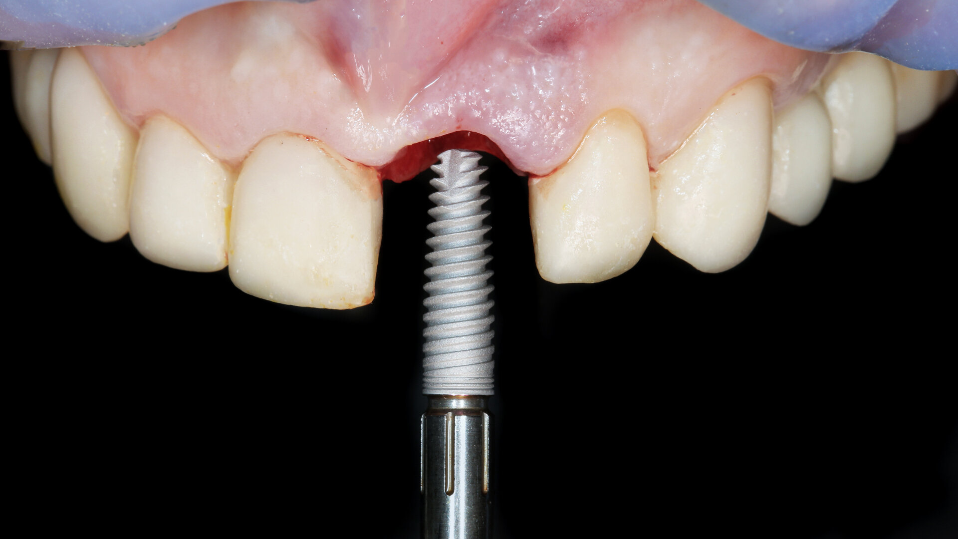 Copycat brands are putting pressure on the dental implants