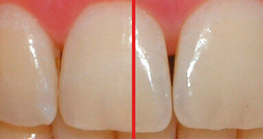Valutazione clinica dell’azione sbiancante  di un dentifricio a base di biossido di titanio  con attivazione a luce led