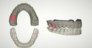 L’intelligenza artificiale può automatizzare la progettazione di protesi biomimetiche per singoli denti