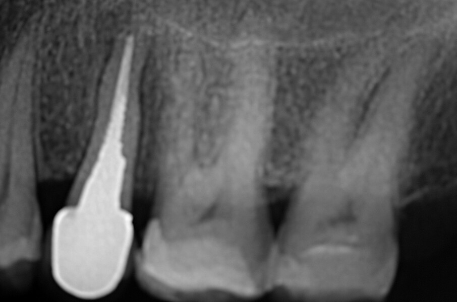 Fig. 12 : Dent irrécupérable. 
