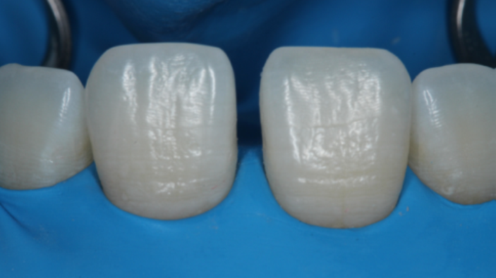 Fig. 3: Maxillary anterior teeth were isolated with a rubber dam