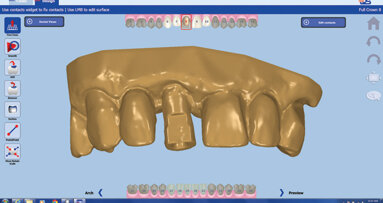 Two-day custom abutments and crowns from intraoral scans