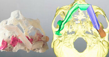 Chirurgia orale e maxillo-facciale: Rivoluzionata dai modelli 3D stampati