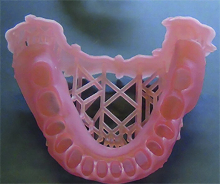 Fig. 21a: 3D printing with Form 2 resin for a complete removable prosthesis (denture base and denture teeth). Denture tooth resin is used for both prosthetic teeth for removable prostheses and temporary teeth.