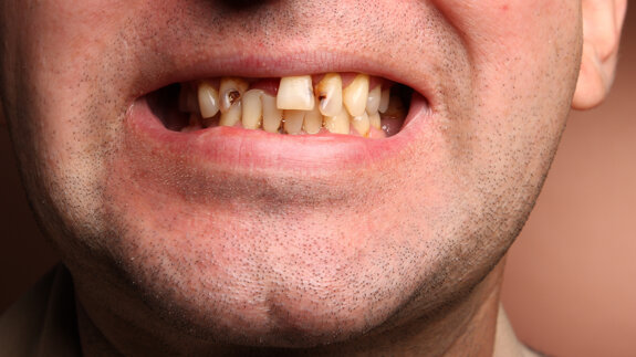Dentists fear DIY tooth extractions as Wales hikes NHS fees