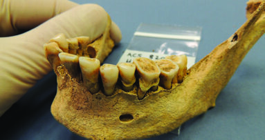 使用古代牙齿细菌追踪疾病进化过程