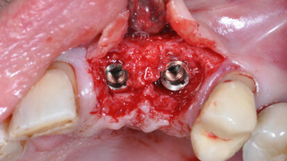 Interview: Periodontitis and peri-implantitis in implant dentistry
