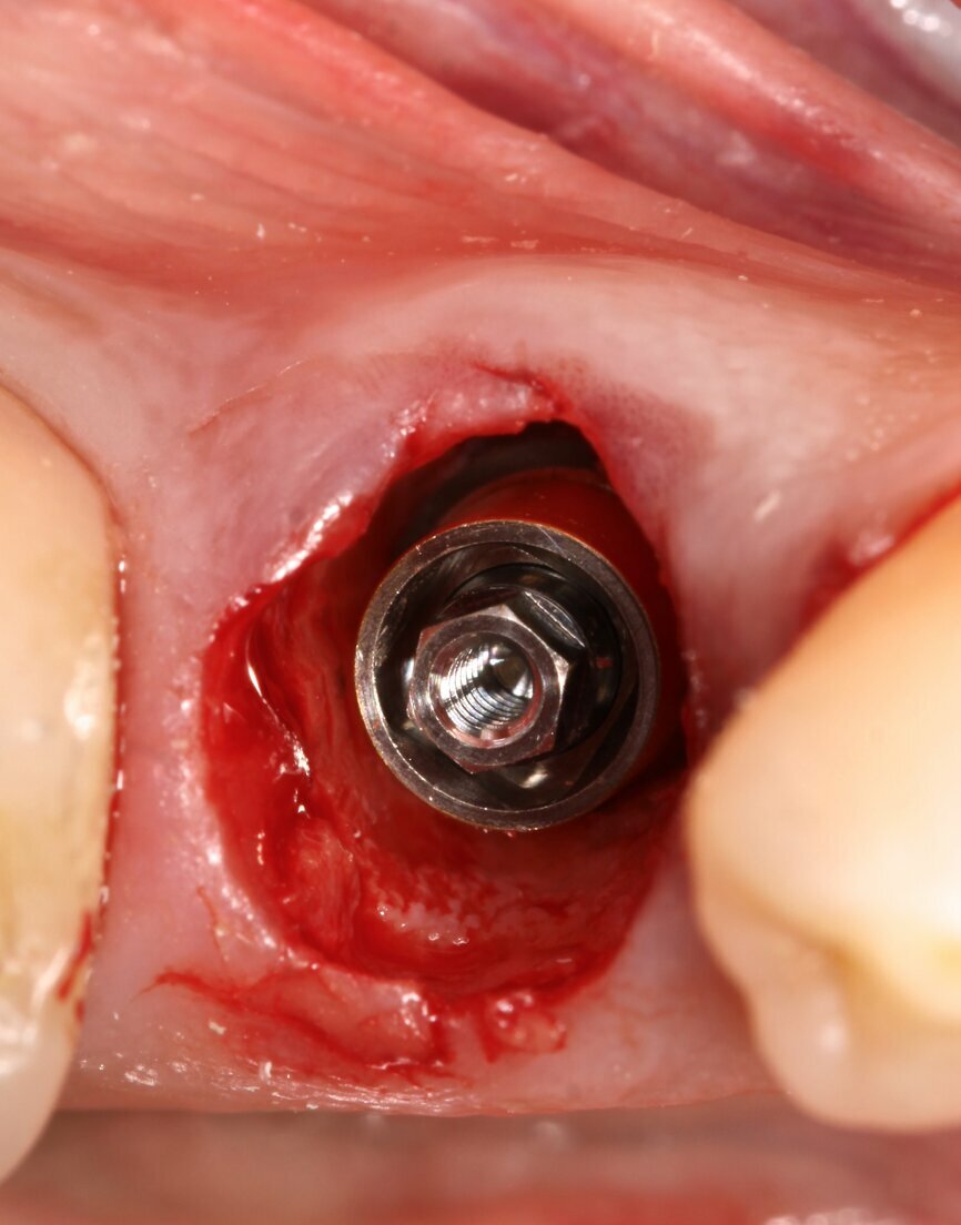 Fig. 4: Implant with intermediate abutment.