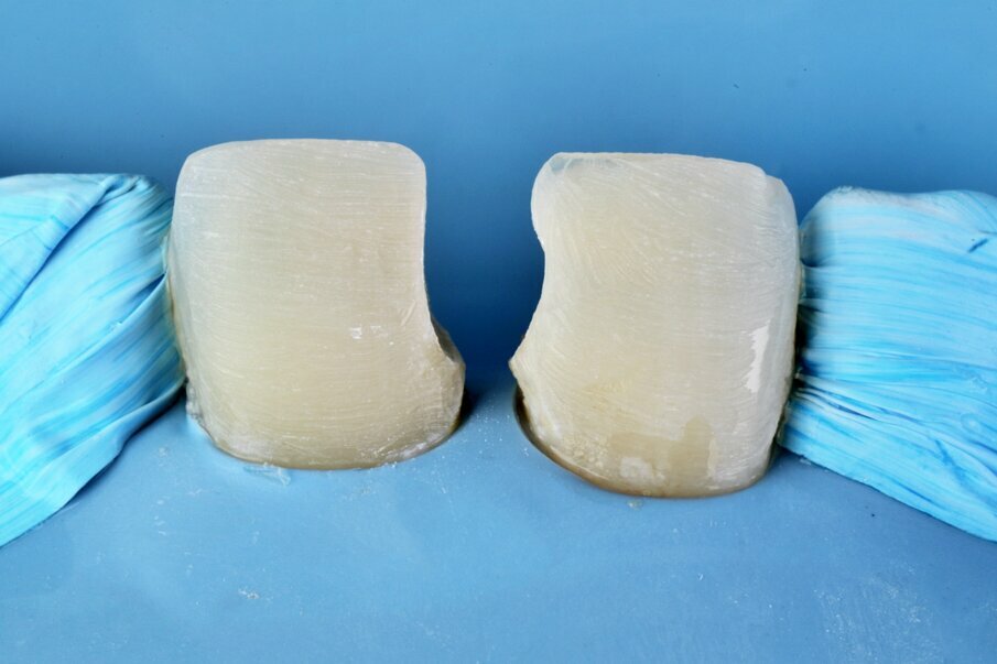Fig. 3: After removal of old composite restorations on tooth #11 & 21 and minimal tooth preparation for direct veneers with Shofu Diamond Points.