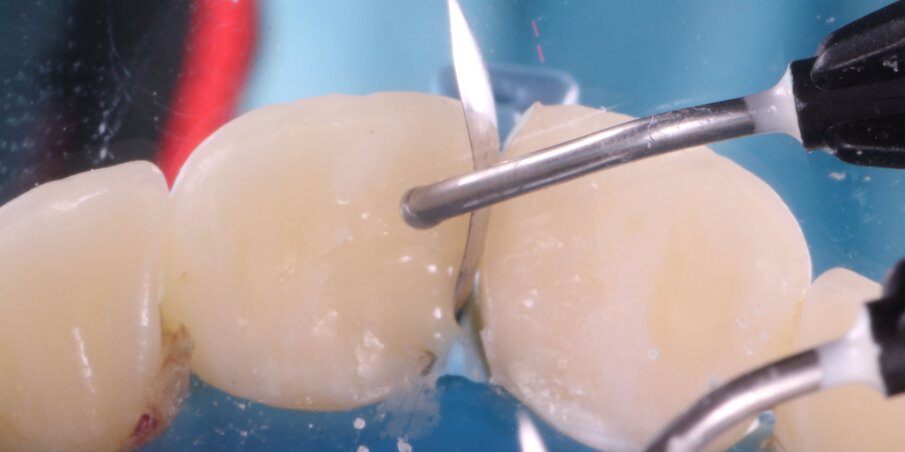Fig 10. A small amount of flowable resin is placed and not cured.Composite is then condensed palatally until it stops flowing out from the buccal.