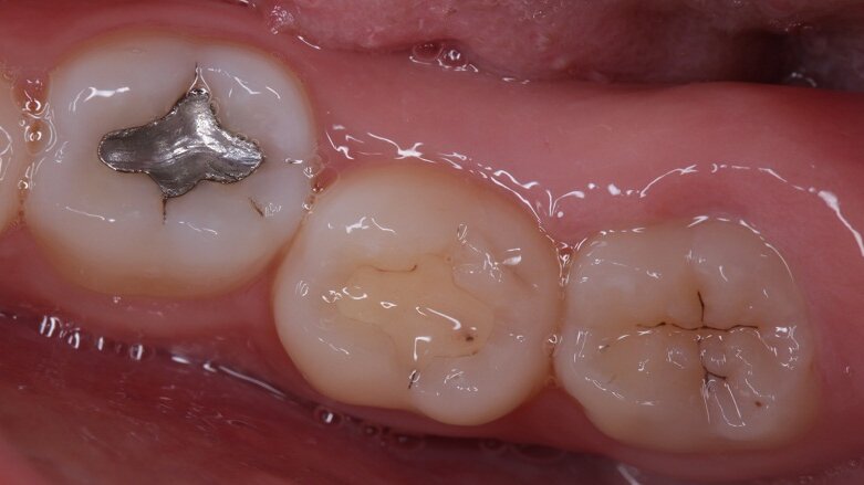 Dental amalgam reduction endorsed by EU enters into effect