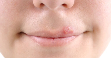Weltneuheit kann Lippenherpes-Ausbrüche verhindern