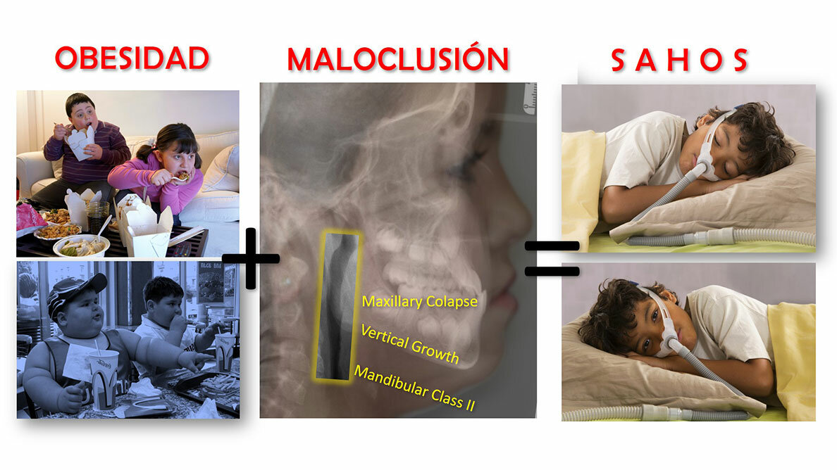 Principales Causas de la apnea del sueño - Clínica de ortodoncia
